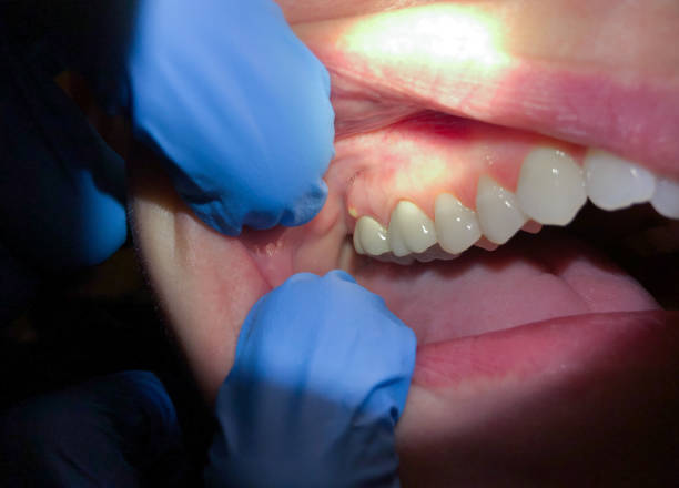 Best Dentist for Tooth Abscess  in Carrier Mls, IL