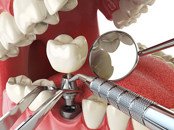 Best Chipped Tooth Repair Near Me  in Carrier Mls, IL